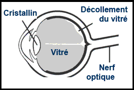 Diagramme illustrant le fonds de l'oeil atteint d'un décollement de la rétine