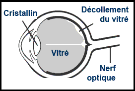 Diagramme illustrant le fonds de l'oeil atteint d'un décollement du vitré