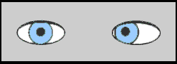 Diagram of a person with esotropia or "crossed eyes"